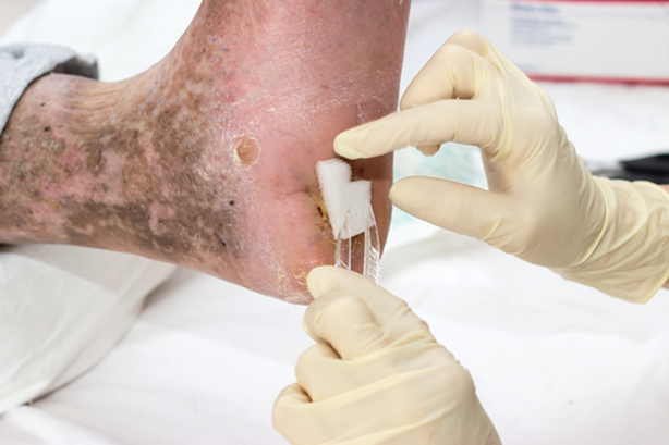 Soins de plaies Soins de plaies